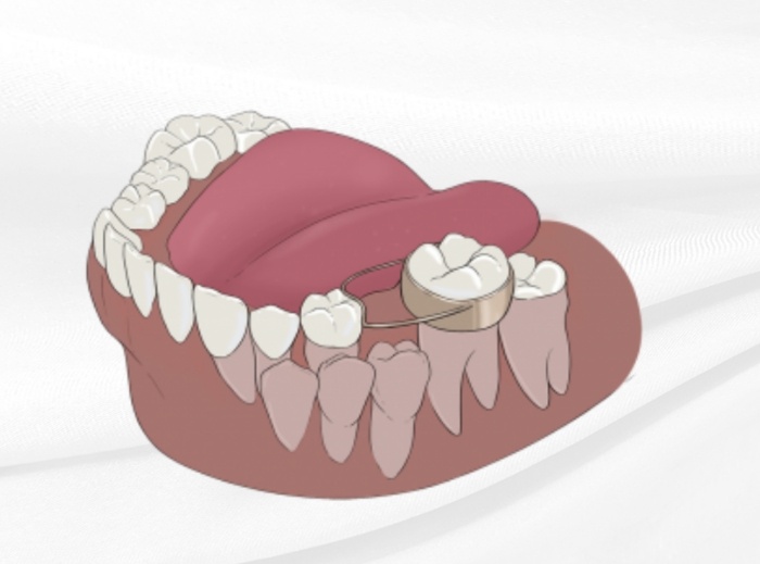 Animated smile showing how space maintainers work