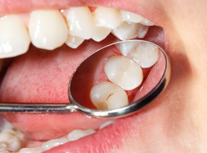 Closeup of damaged smile in need of protective dental sealants