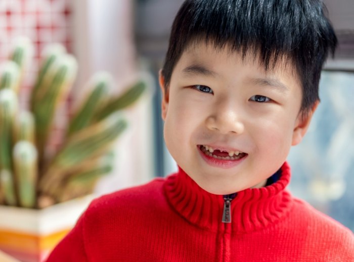 Closeup of child with missing teeth after tooth extractions