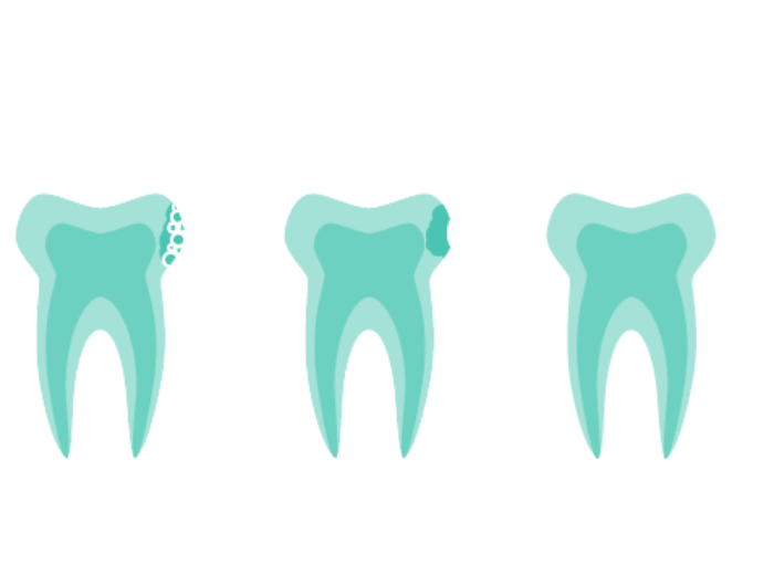 Animated tooth showing the icon resin infiltration treatment process
