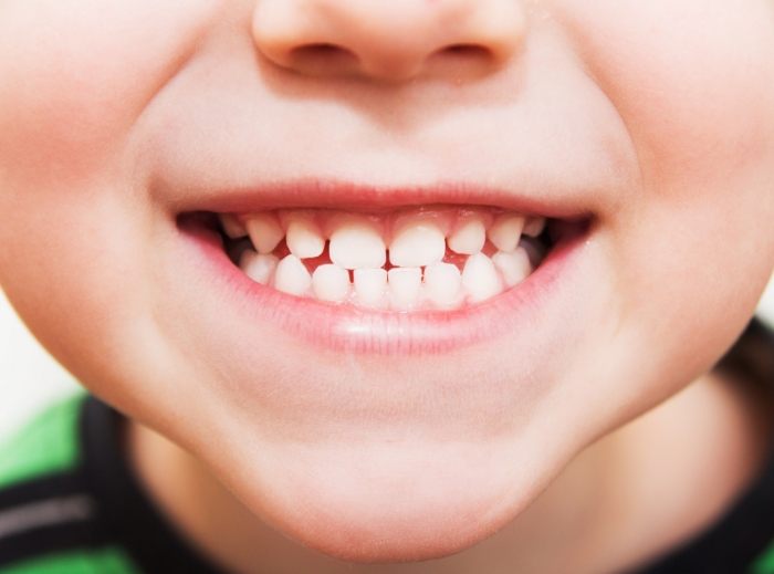 Closeup of child's smile after tooth colored fillings